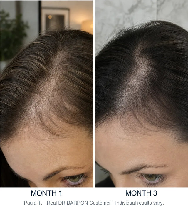 Before and after, Paula T., Real DR BARRON Customer, month 1 to month 3. Individual results vary.