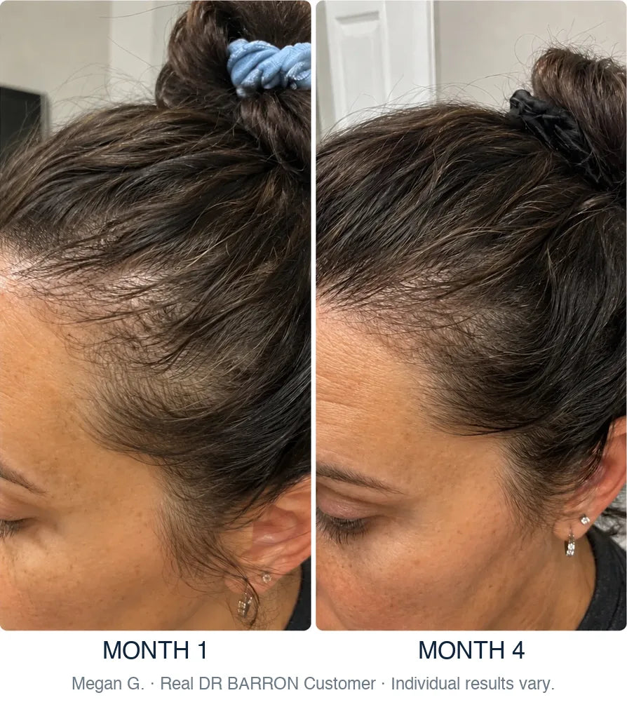 Before and after, Megan G., Real DR BARRON Customer, month 1 to month 4. Individual results vary.