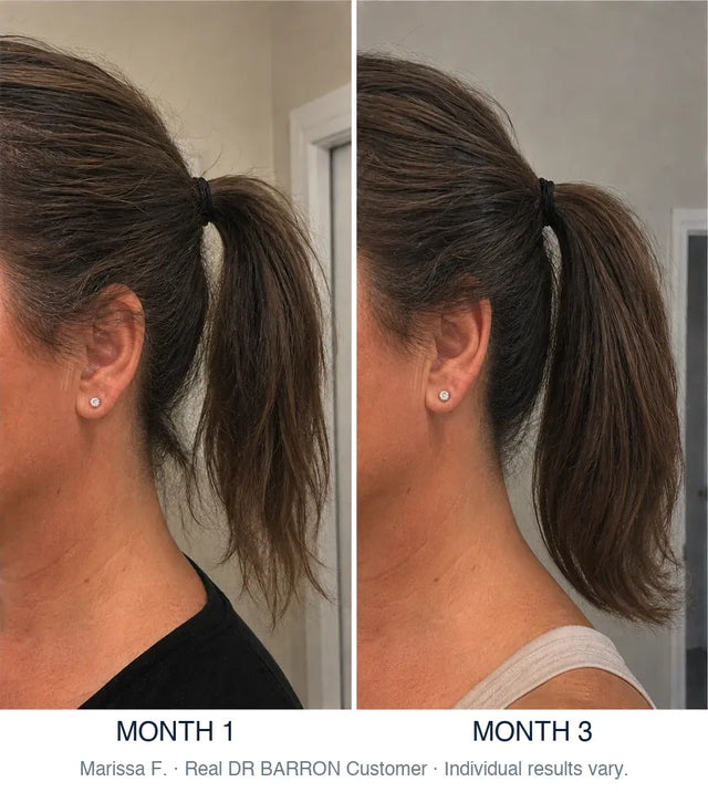 Before and after, Marissa F., Real DR BARRON Customer, month 1 to month 3. Individual results vary.