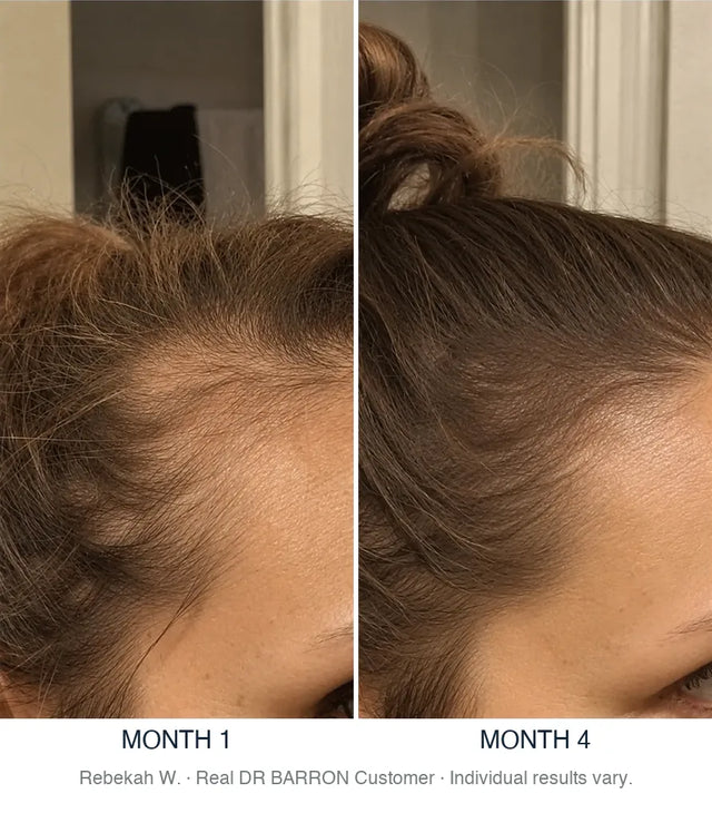Before and after, Rebekah W., Real DR BARRON Customer, month 1 to month 4. Individual results vary.